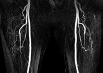MRI Angiogram
